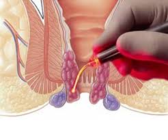 Laser Piles Surgery